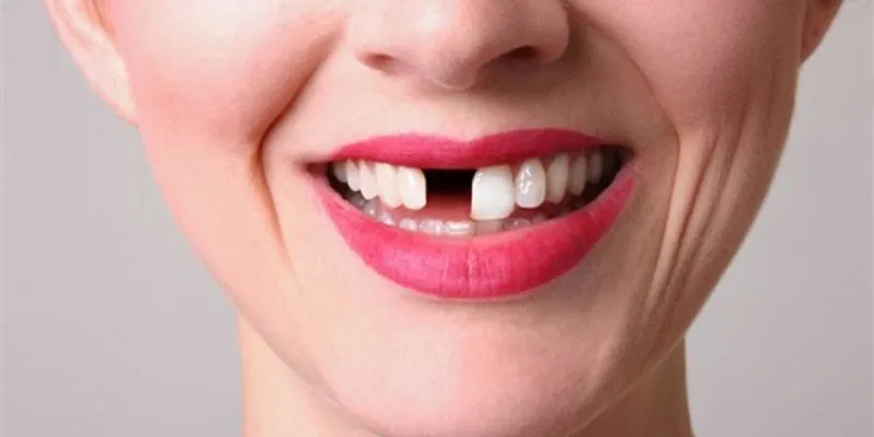 Nằm mơ rụng răng có ý nghĩa gì? Con số đề may mắn kèm theo 2 Những điềm báo khi nằm mơ rụng răng