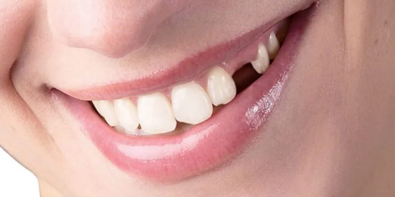 Nằm mơ rụng răng có ý nghĩa gì? Con số đề may mắn kèm theo 3 Ý nghĩa khi mơ thấy răng cửa bị rụng